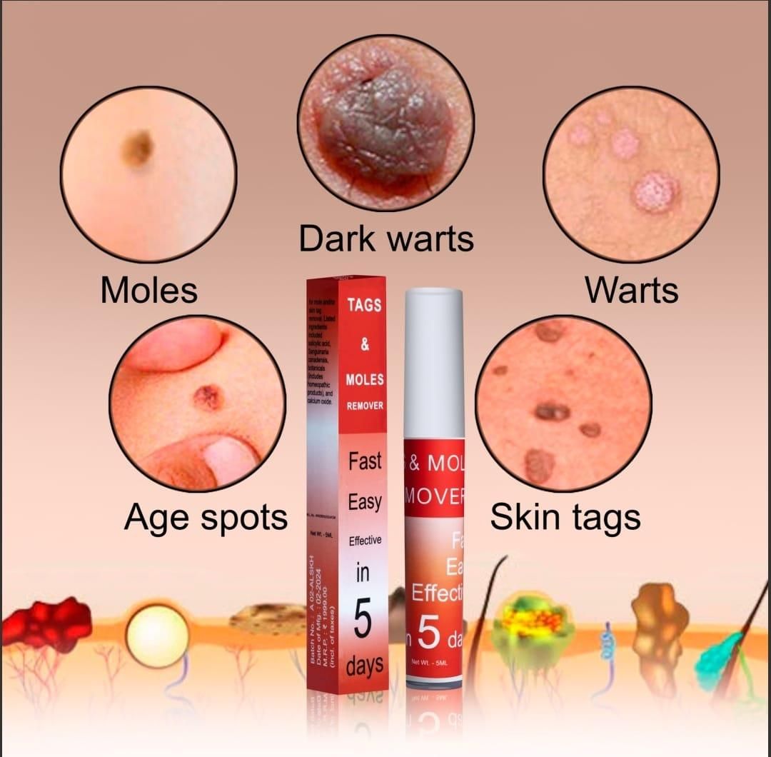TagMo™ - Tags & Moles Remover (Buy 1 Get 1 Free🔥🔥)