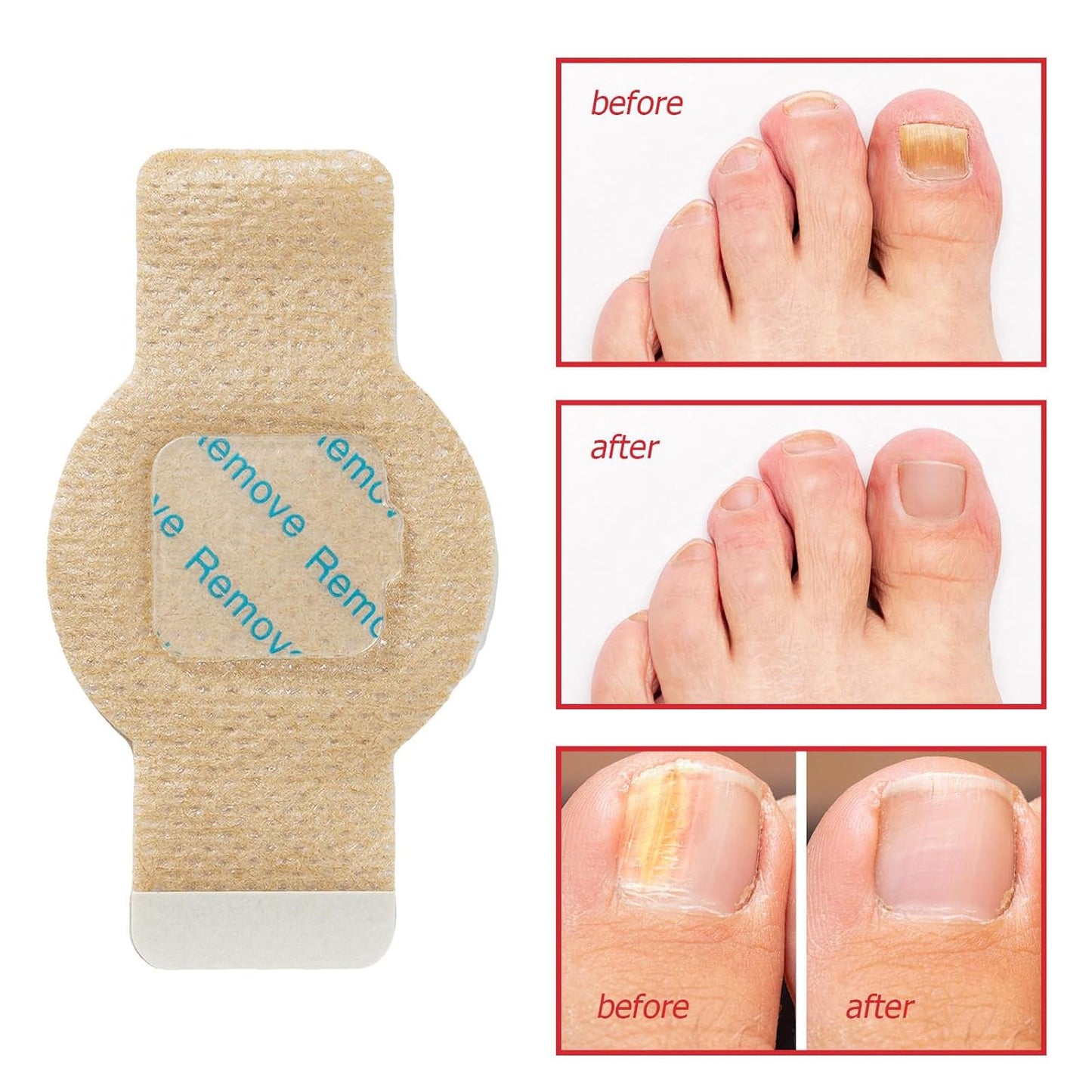NailHeal - Fungal Nail Patches 🌿💅 ( Buy 1 Get 1 Free🔥🔥)