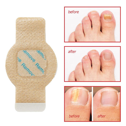 NailHeal - Fungal Nail Patches 🌿💅 ( Buy 1 Get 1 Free🔥🔥)